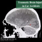 P&N BLOG | Traumatic Brain Injuries in Car Accidents