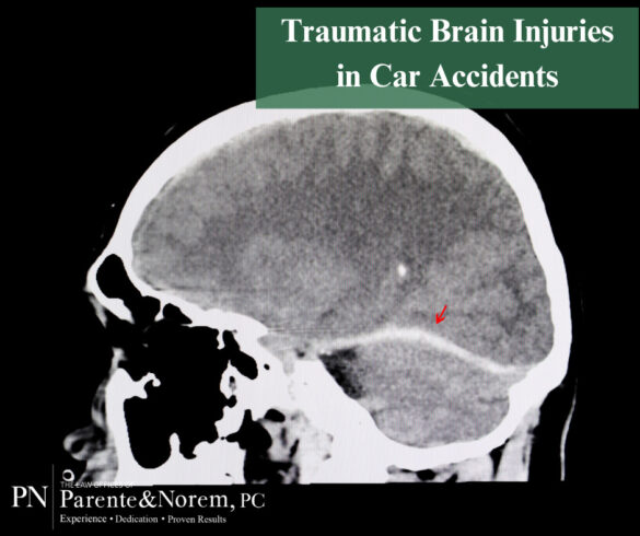 P&N BLOG | Traumatic Brain Injuries in Car Accidents